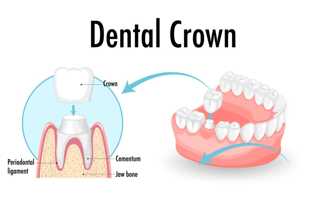 dental crown