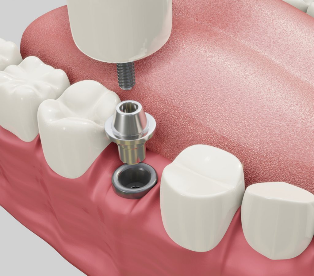 dental implants