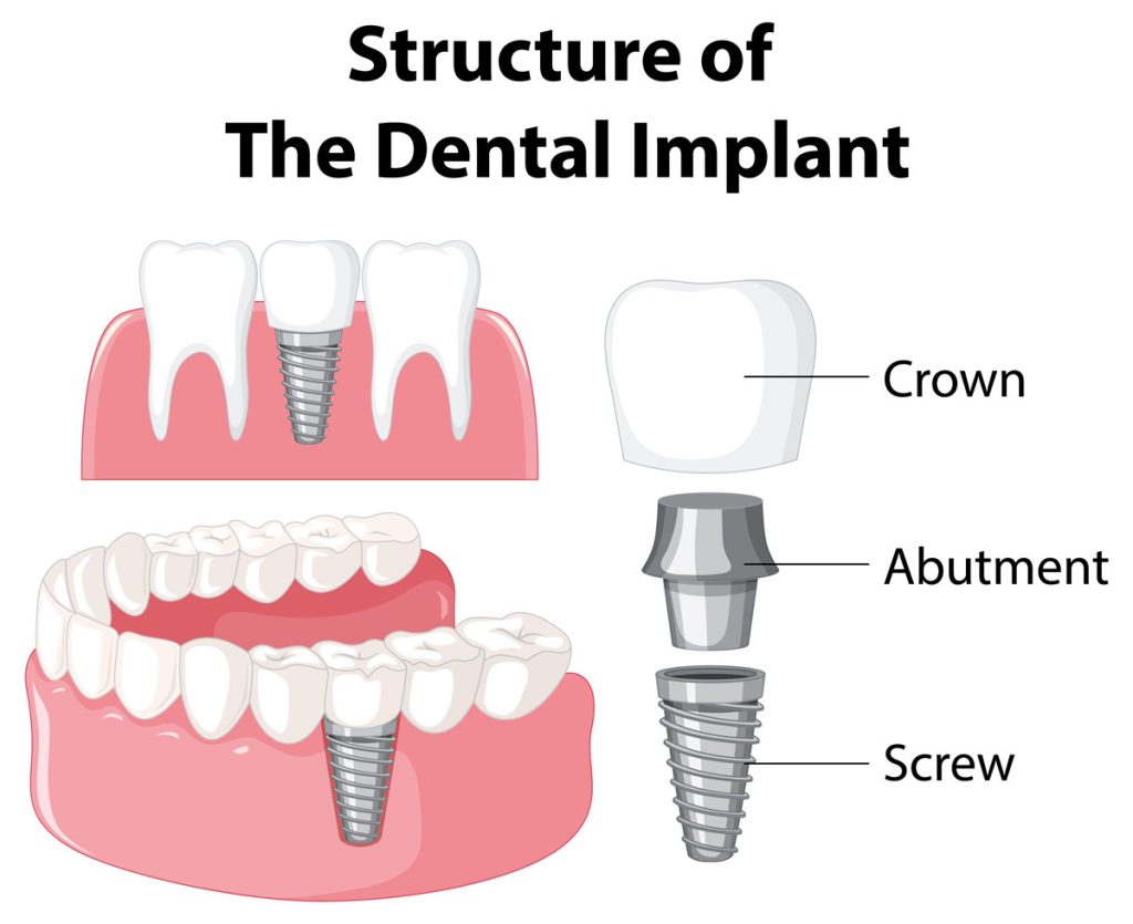 dental implant structure