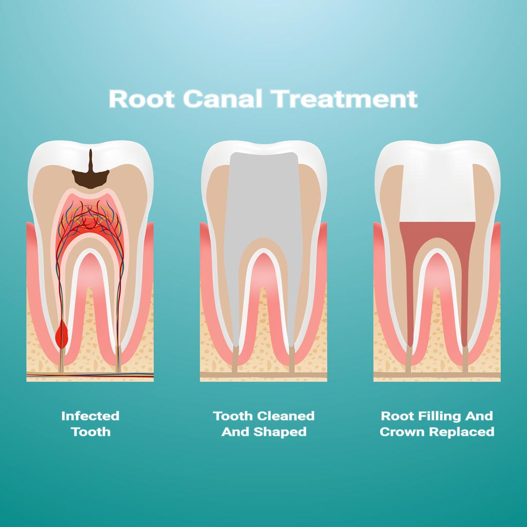 root canal treatment