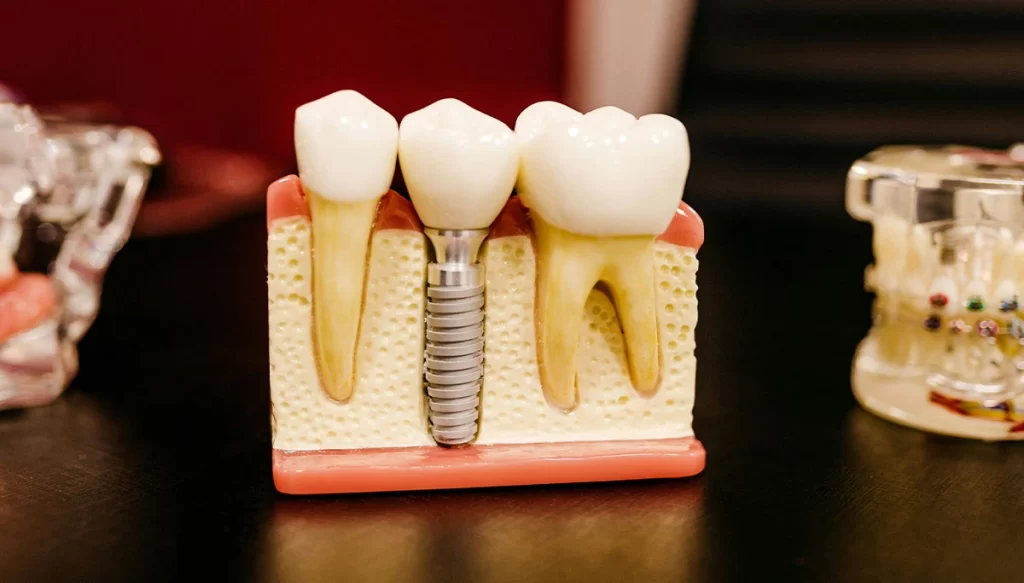 Dental Implants