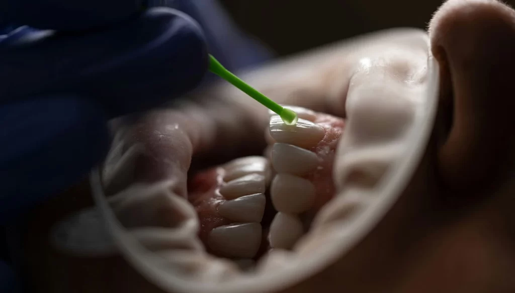 Teeth Whitening