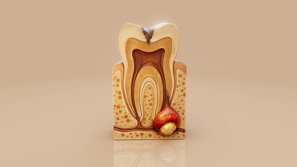 Dental Infection